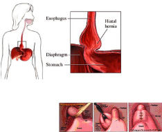 Hernia hiatal por deslizamiento y su reparación quirúrgica.