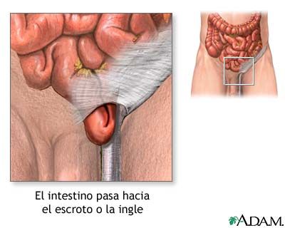 Hernia inguinal.